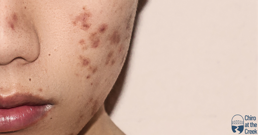 What Causes Acne? Why Zinc Is The Answer!